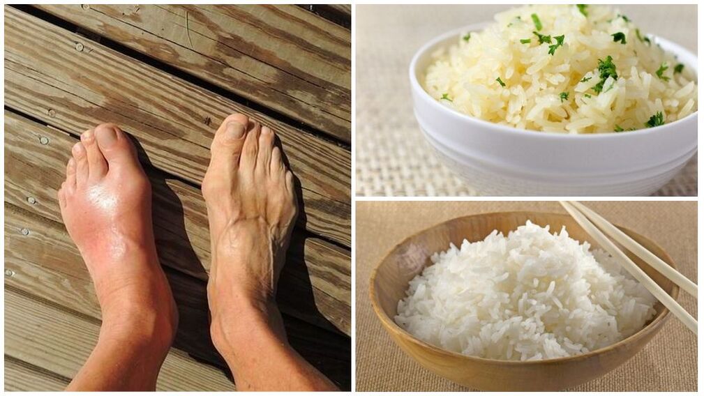 Diet berasaskan nasi disyorkan untuk pesakit gout. 
